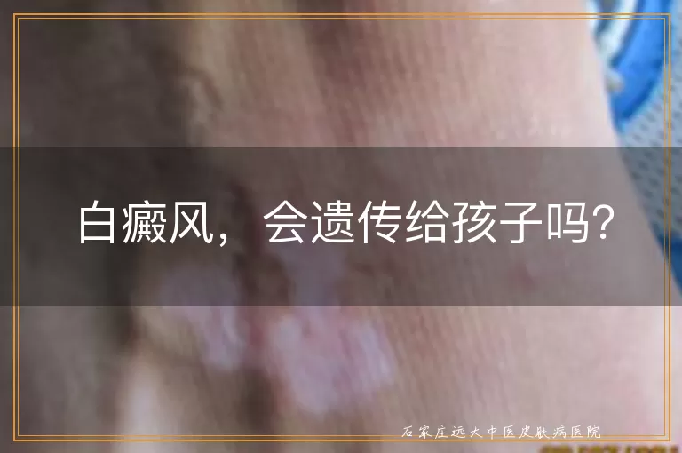 白癜风，会遗传给孩子吗？