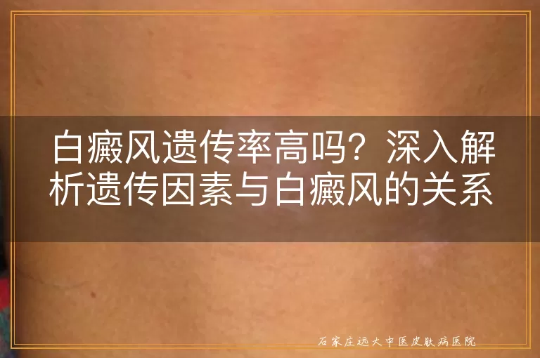 白癜风遗传率高吗？深入解析遗传因素与白癜风的关系