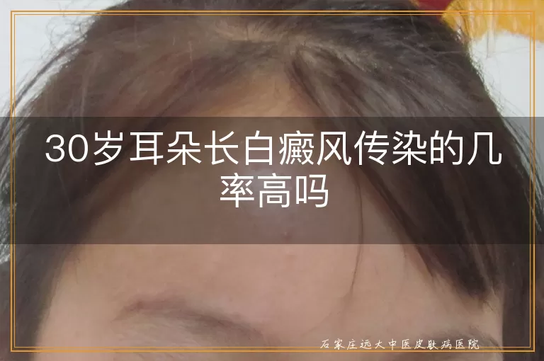 30岁耳朵长白癜风传染的几率高吗