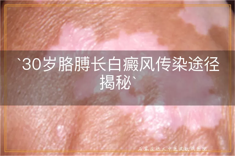 30岁胳膊长白癜风传染途径揭秘