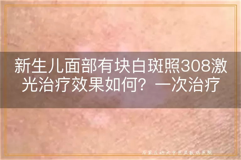 新生儿面部有块白斑照308激光治疗效果如何？一次治疗费用多少？