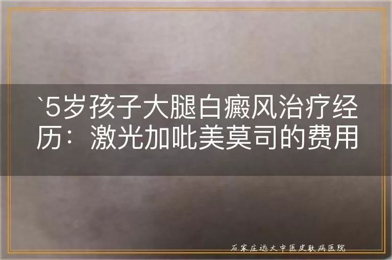 5岁孩子大腿白癜风治疗经历：激光加吡美莫司的费用与效果