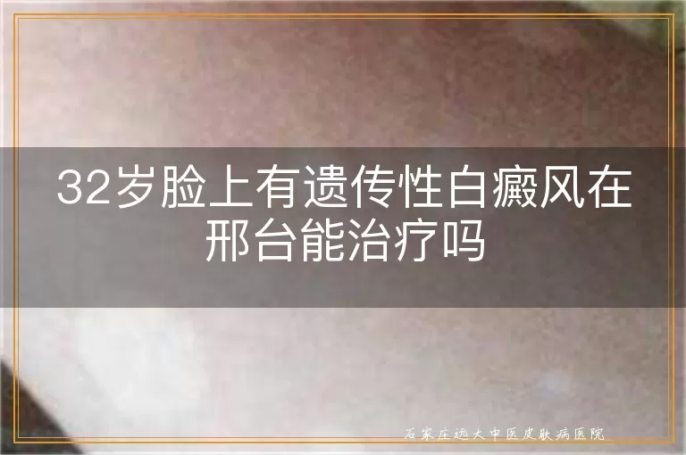 32岁脸上有遗传性白癜风在邢台能治疗吗