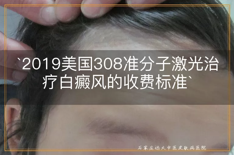 2019美国308准分子激光治疗白癜风的收费标准