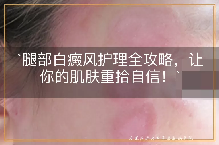 腿部白癜风护理全攻略，让你的肌肤重拾自信！