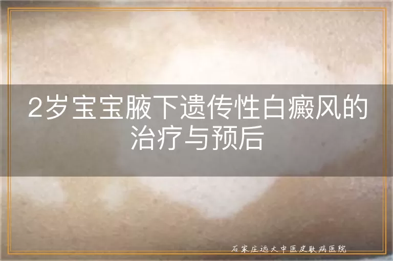 2岁宝宝腋下遗传性白癜风的治疗与预后