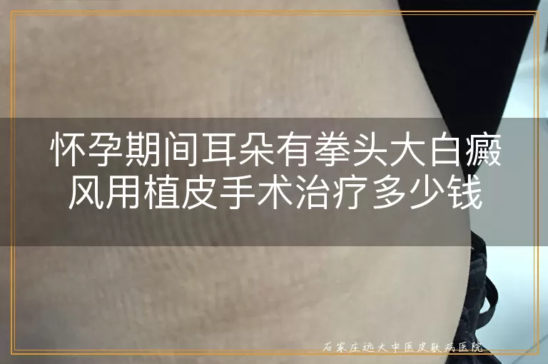 怀孕期间耳朵有拳头大白癜风用植皮手术治疗多少钱