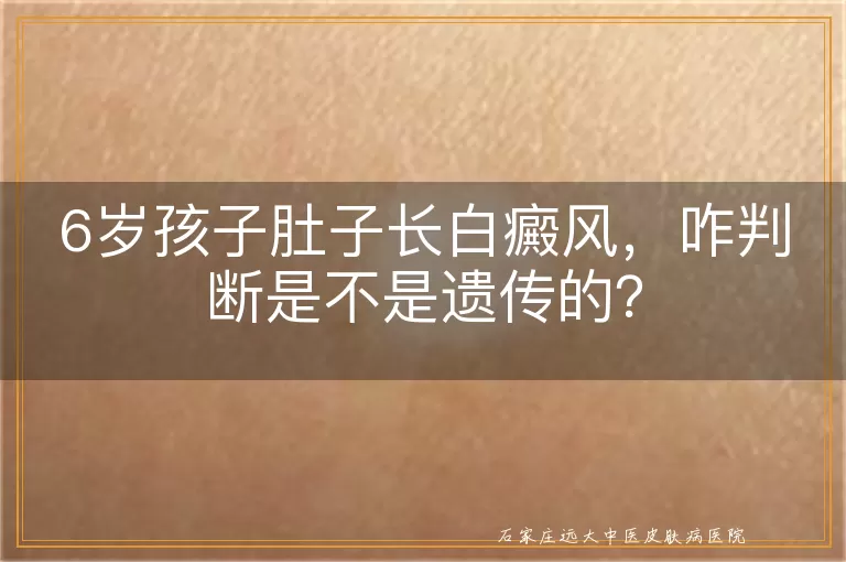 6岁孩子肚子长白癜风，咋判断是不是遗传的？