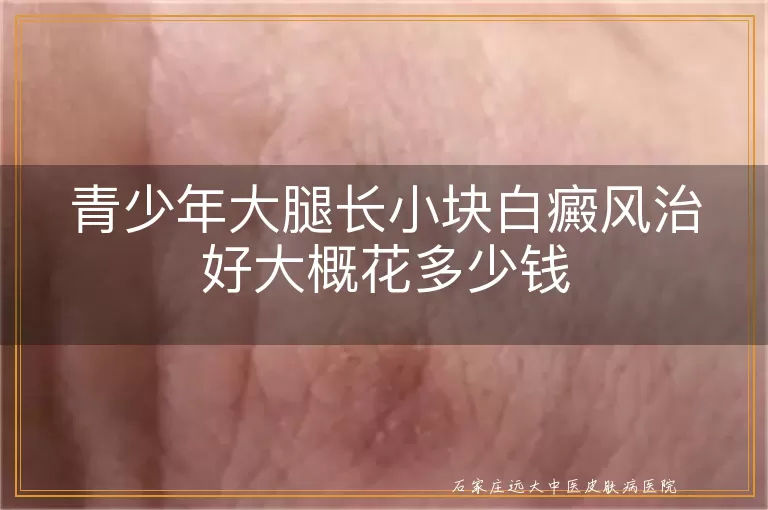 青少年大腿长小块白癜风治好大概花多少钱