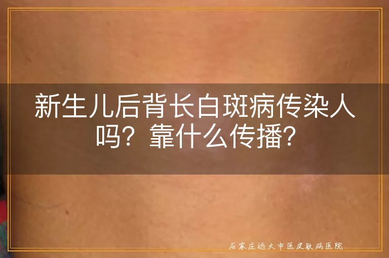 新生儿后背长白斑病传染人吗？靠什么传播？
