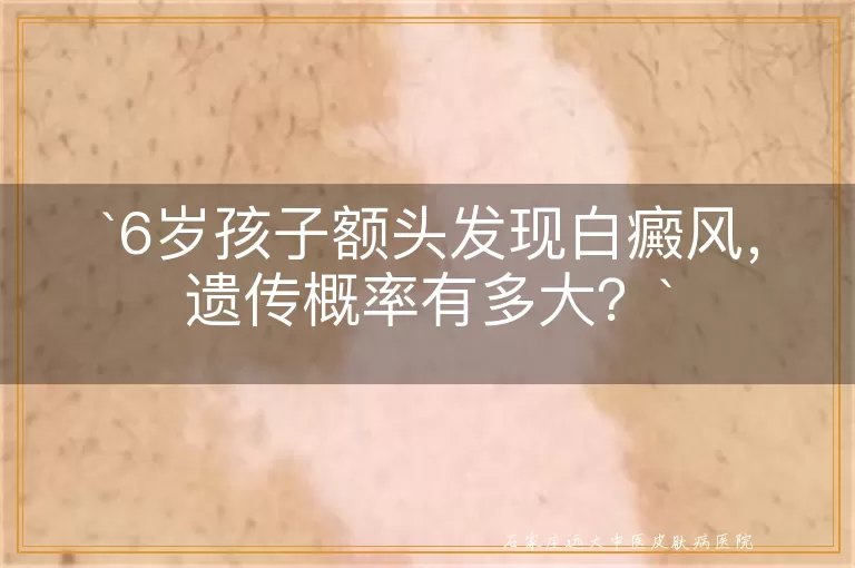 6岁孩子额头发现白癜风，遗传概率有多大？
