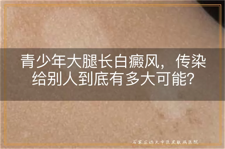 青少年大腿长白癜风，传染给别人到底有多大可能？