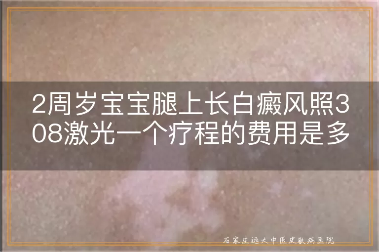 2周岁宝宝腿上长白癜风照308激光一个疗程的费用是多少？
