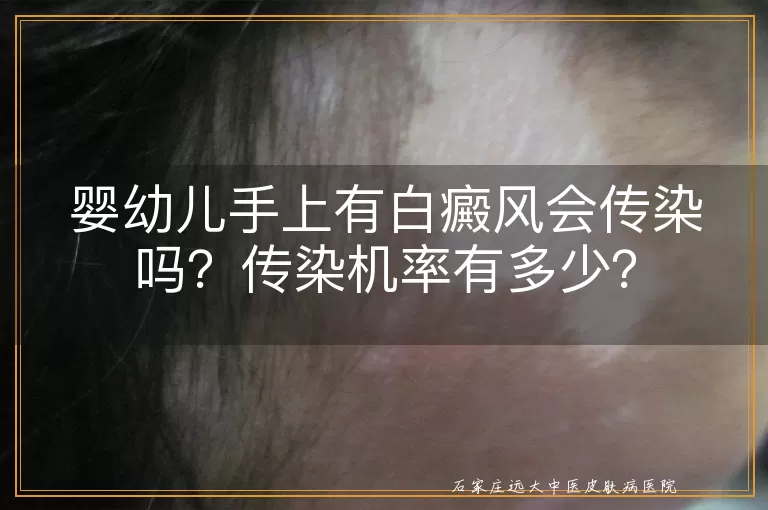 婴幼儿手上有白癜风会传染吗？传染机率有多少？