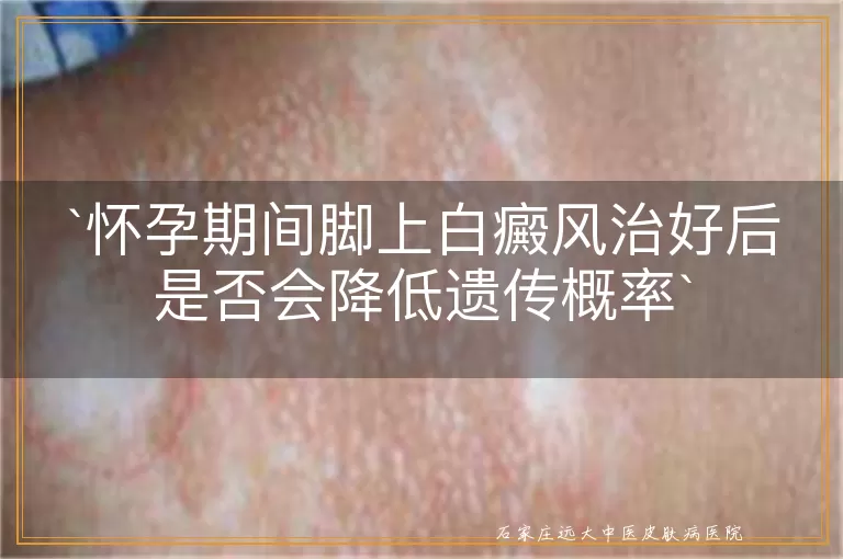 怀孕期间脚上白癜风治好后是否会降低遗传概率