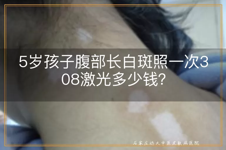 5岁孩子腹部长白斑照一次308激光多少钱？