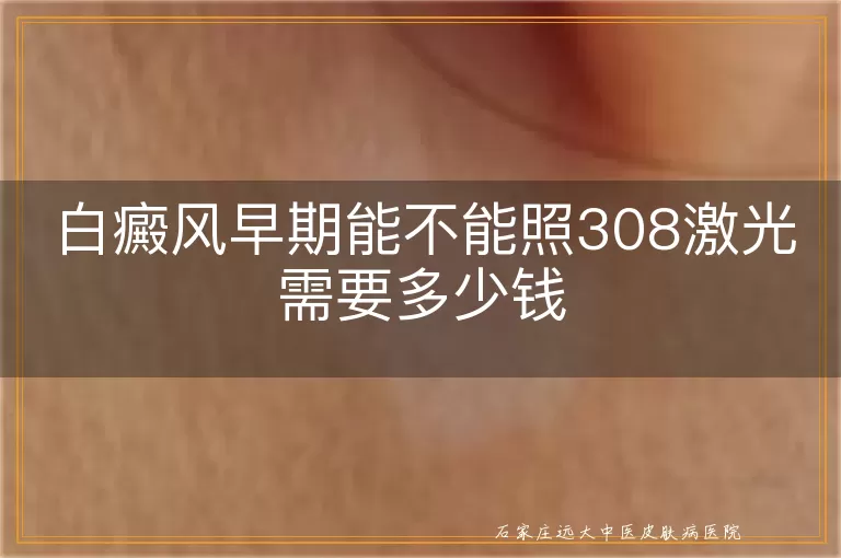 白癜风早期能不能照308激光需要多少钱
