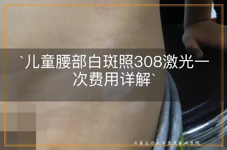 儿童腰部白斑照308激光一次费用详解