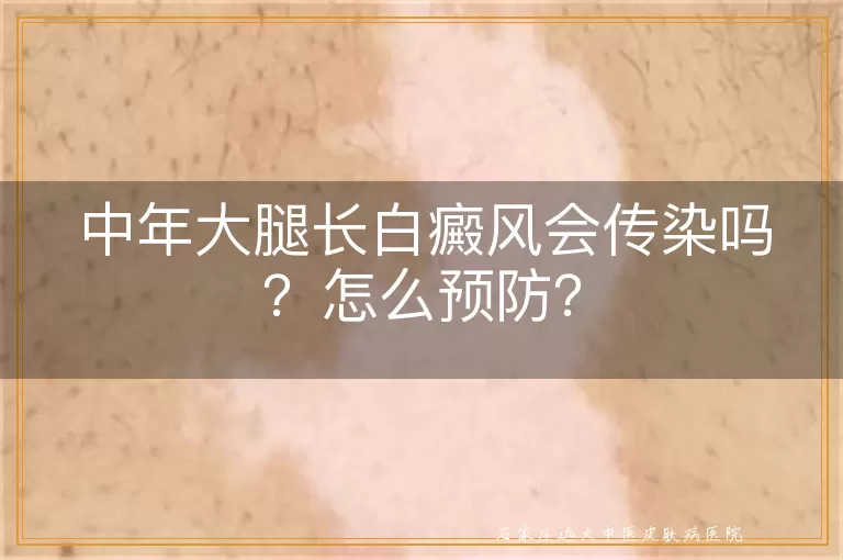 中年大腿长白癜风会传染吗？怎么预防？