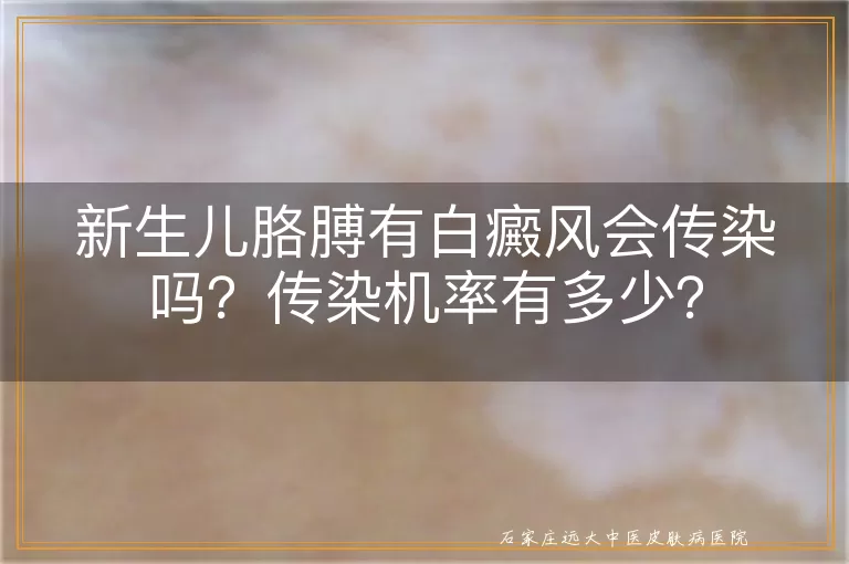 新生儿胳膊有白癜风会传染吗？传染机率有多少？