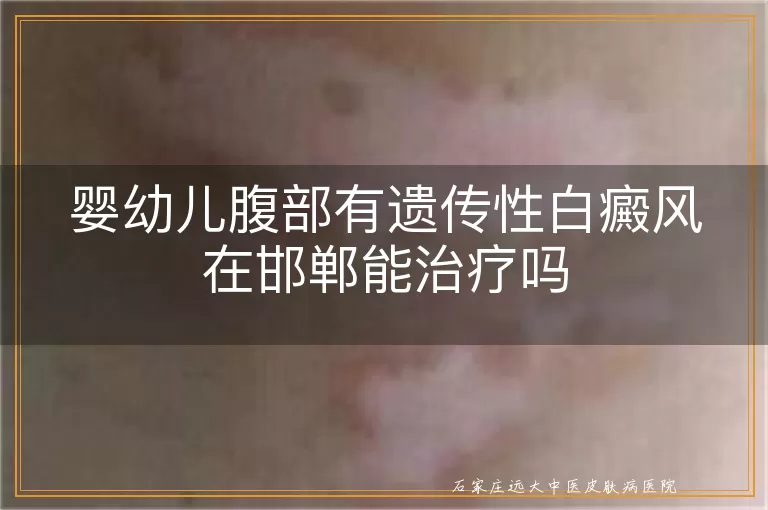 婴幼儿腹部有遗传性白癜风在邯郸能治疗吗