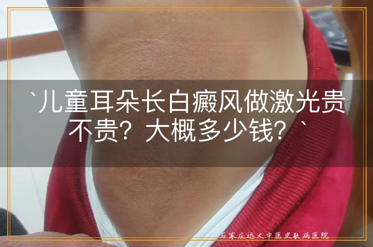 儿童耳朵长白癜风做激光贵不贵？大概多少钱？