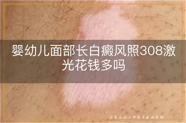 婴幼儿面部长白癜风照308激光花钱多吗