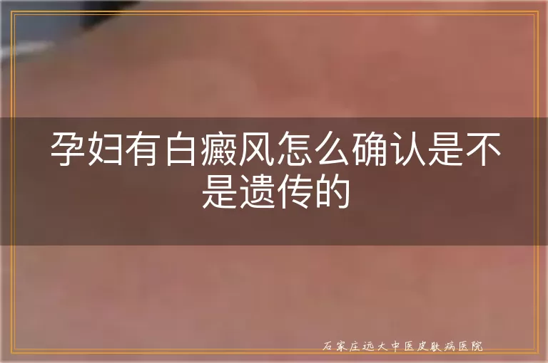 孕妇有白癜风怎么确认是不是遗传的
