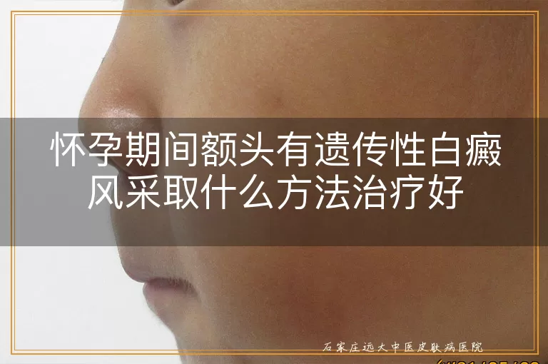 怀孕期间额头有遗传性白癜风采取什么方法治疗好