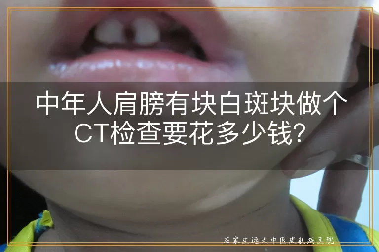 中年人肩膀有块白斑块做个CT检查要花多少钱？