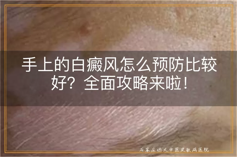 手上的白癜风怎么预防比较好？全面攻略来啦！