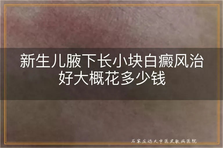 新生儿腋下长小块白癜风治好大概花多少钱