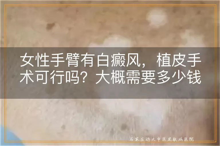 女性手臂有白癜风，植皮手术可行吗？大概需要多少钱？
