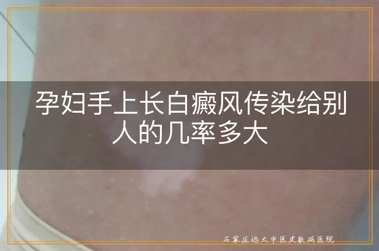 孕妇手上长白癜风传染给别人的几率多大