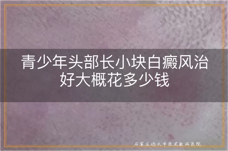 青少年头部长小块白癜风治好大概花多少钱