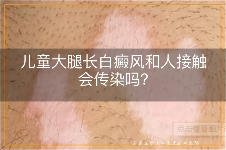 儿童大腿长白癜风和人接触会传染吗？