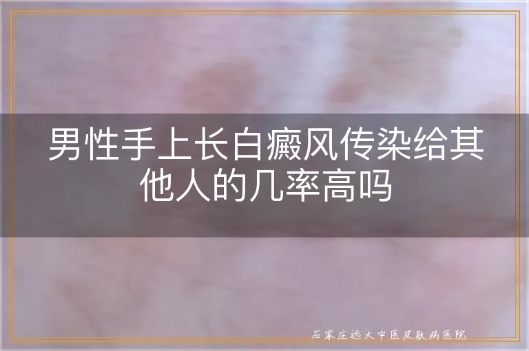 男性手上长白癜风传染给其他人的几率高吗