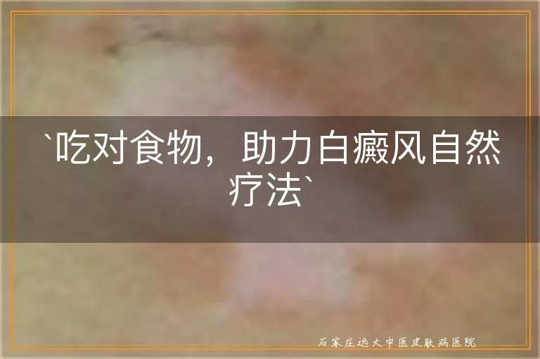 吃对食物，助力白癜风自然疗法