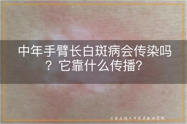 中年手臂长白斑病会传染吗？它靠什么传播？