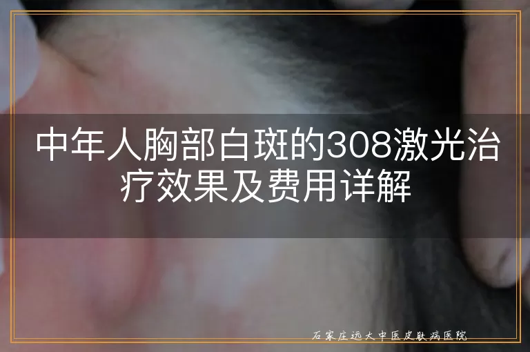 中年人胸部白斑的308激光治疗效果及费用详解