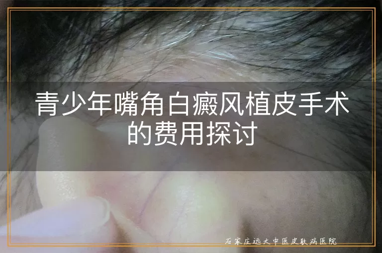 青少年嘴角白癜风植皮手术的费用探讨