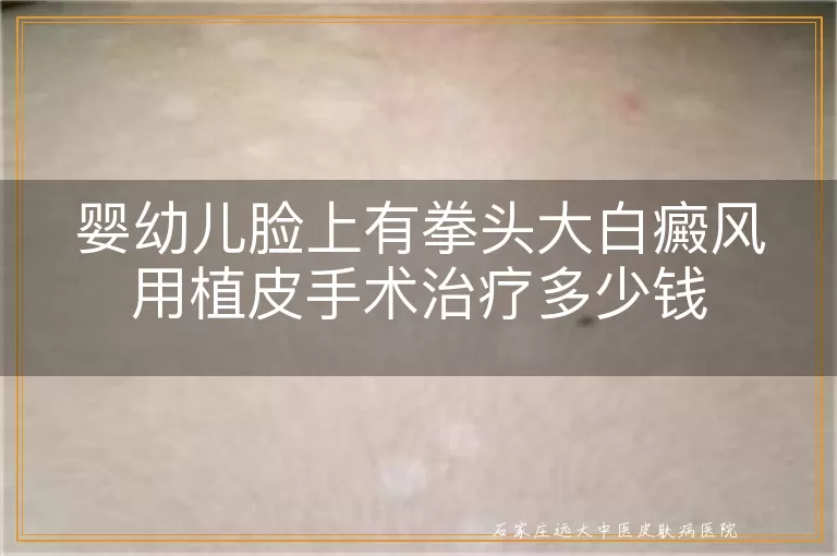 婴幼儿脸上有拳头大白癜风用植皮手术治疗多少钱