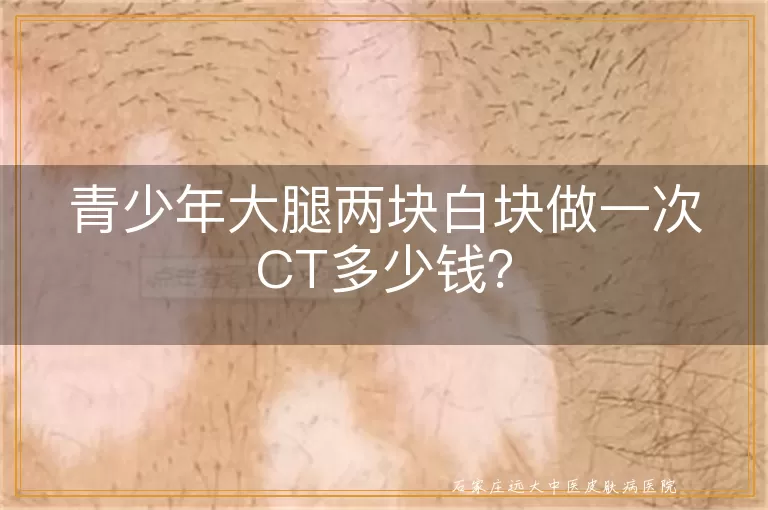 青少年大腿两块白块做一次CT多少钱？