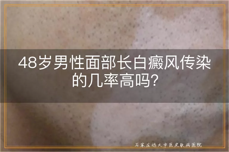 48岁男性面部长白癜风传染的几率高吗？