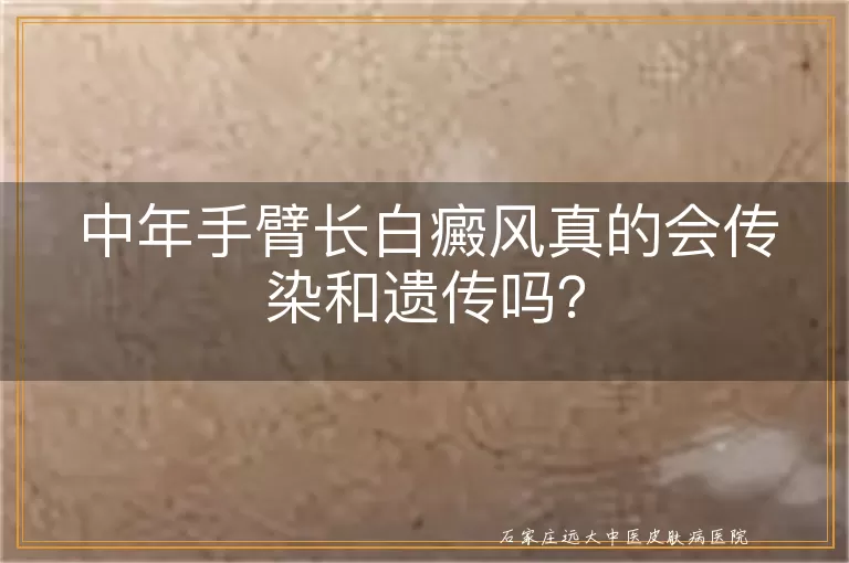 中年手臂长白癜风真的会传染和遗传吗？