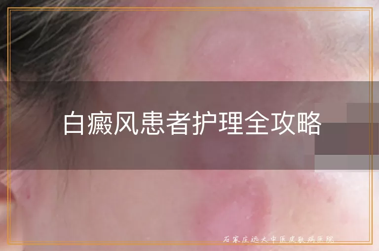 白癜风患者护理全攻略