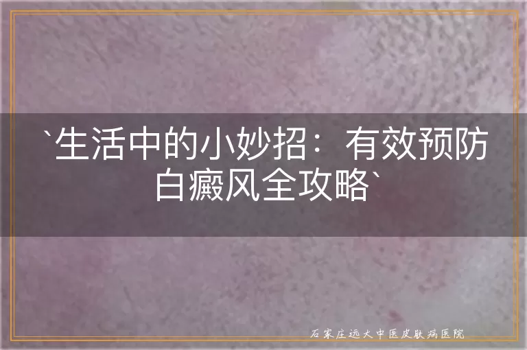 生活中的小妙招：有效预防白癜风全攻略