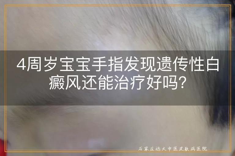 4周岁宝宝手指发现遗传性白癜风还能治疗好吗?