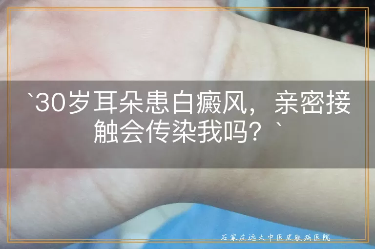 30岁耳朵患白癜风，亲密接触会传染我吗？