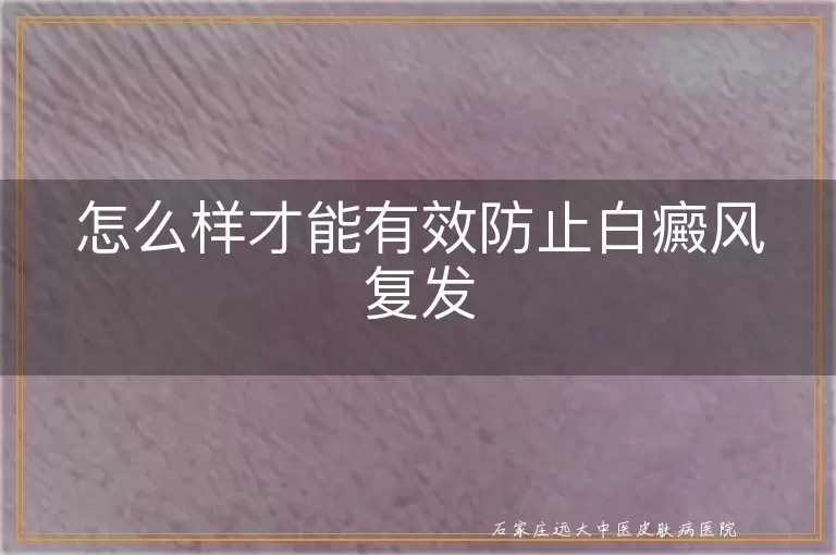 怎么样才能有效防止白癜风复发